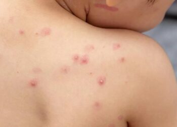 Vaiolo delle scimmie, sette persone contagiate in Fvg